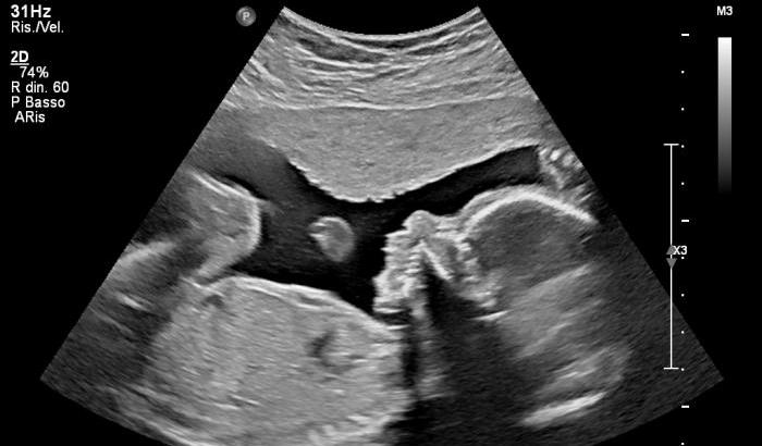 La placenta come scudo per proteggere il feto delle madri Covid-19
